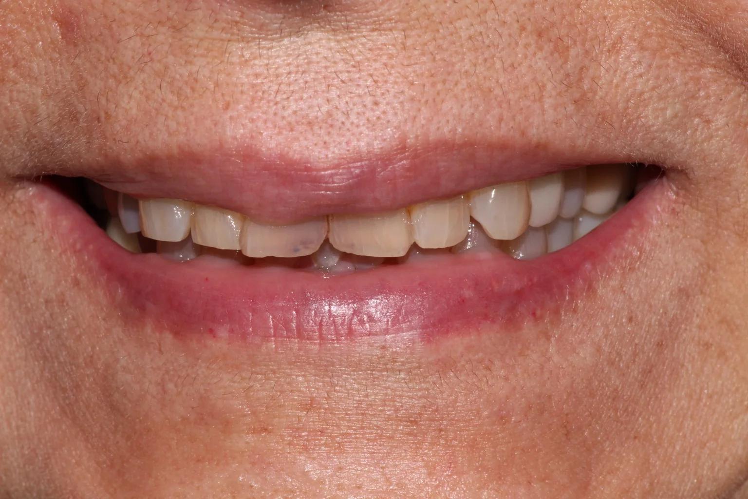 Después de blanqueamiento dental en Miraflores