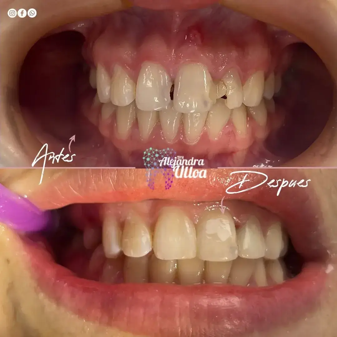 Caso de éxito estética dental en Miraflores 2