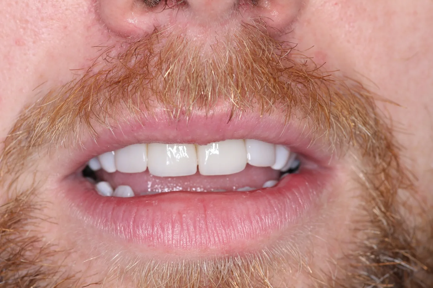 Caso de éxito de estética dental en Miraflores 3