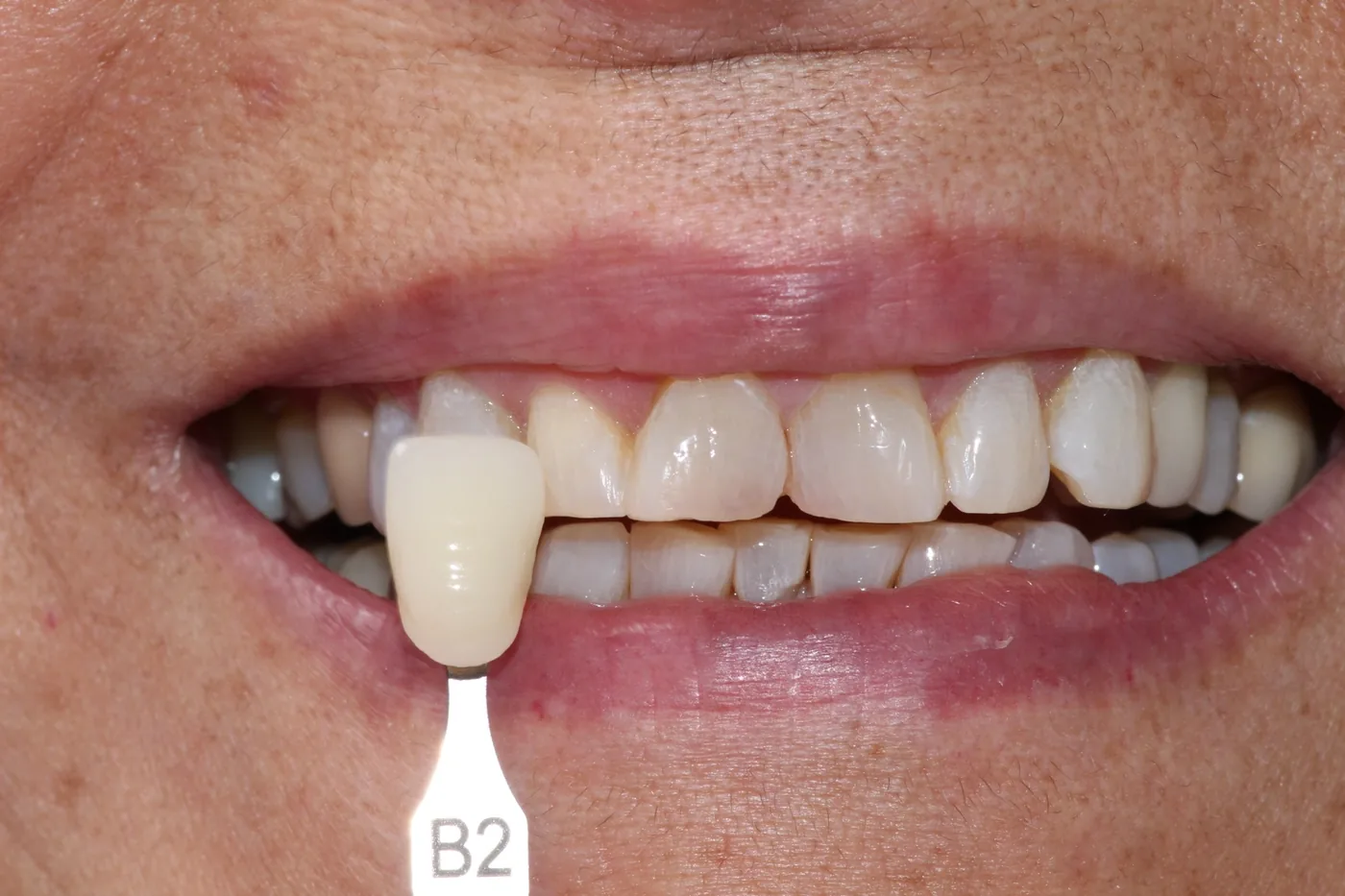 Caso de éxito de estética dental en Miraflores 4